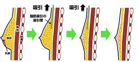 偽性女性化乳房手術イメージ