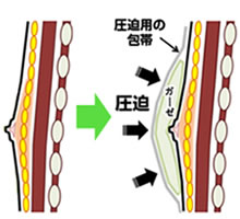偽性女性化乳房手術後の圧迫イメージ