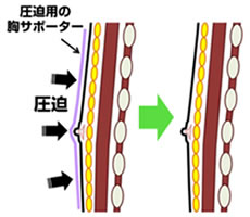 偽性女性化乳房手術後の注意イメージ
