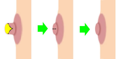 乳頭縮小イメージ