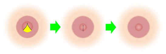 乳頭縮小イメージ2