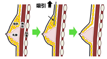 真性女性化乳房手術イメージ