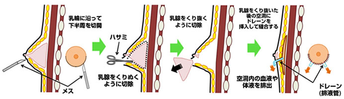 真性女性化乳房手術イメージ2
