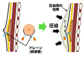 真性女性化乳房手術後の圧迫イメージ