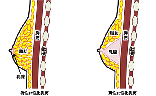 偽性女性化乳房と真性女性化乳房のイメージイラスト