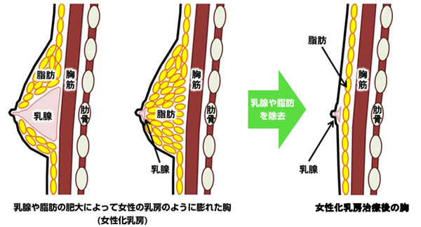 女性化乳房の治療イメージイラスト