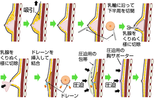 偽性女性化乳房手術